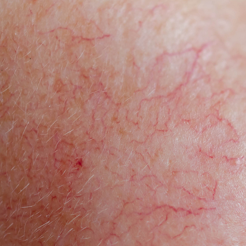 Primer plano de la piel del rostro que muestra enrojecimiento persistente