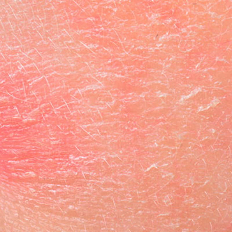 Escamas de enrojecimiento