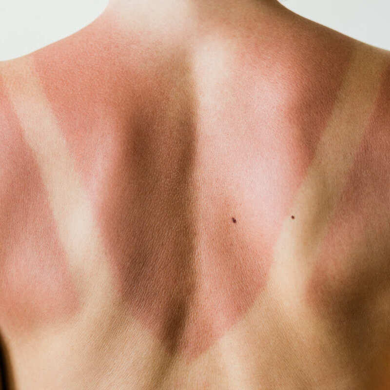 piel y bronceado en la espalda