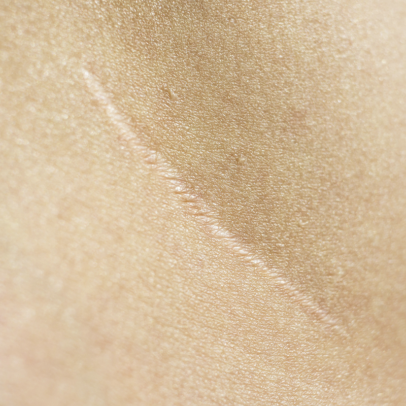 Masaje de cicatrices